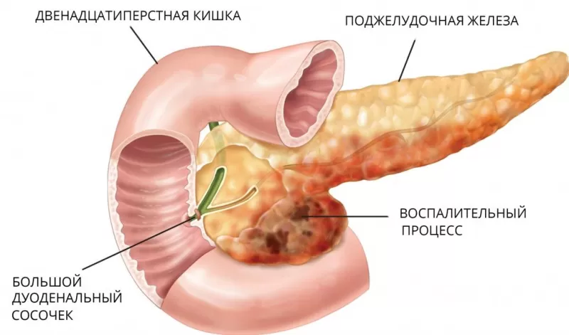 Схематическое изображение поджелудочной железы с панкреатитом