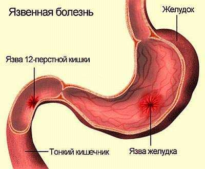 Лечение язвы желудка луковицы 12 перстной кишки thumbnail