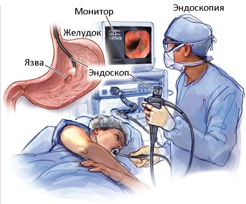Эндоскопия - наиболее распространенный метод диагностики язвы желудка