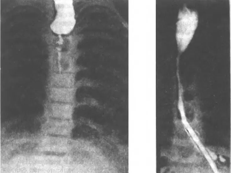 На рентгенограмме можно увидеть степень и распространенность сужения пищевода