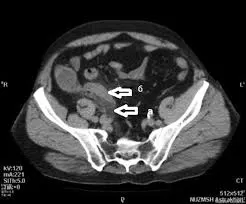 Наиболее информативным методом диагностики данного заболевания является компьютерная томография.