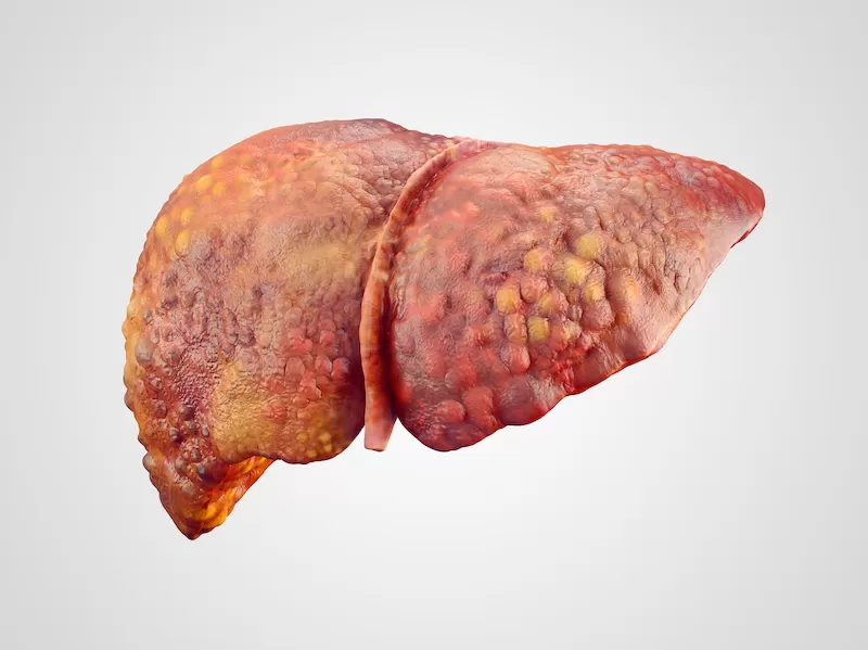 Симптомы рака печени часто совпадают с проявлениями цирроза <br/>Фото: shutterstock.com