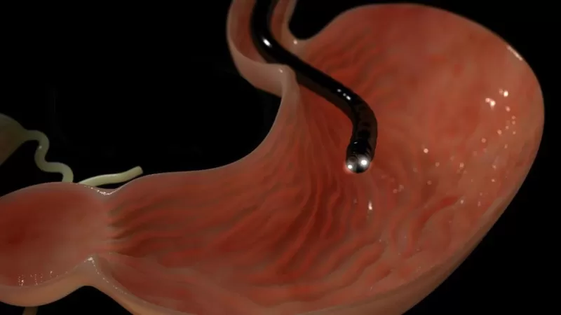 Эндоскопия желудка – основной метод диагностики эрозивного гастрита