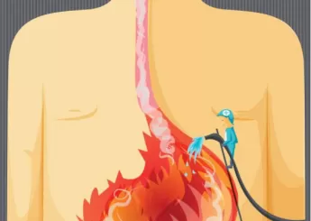 Гастроэзофагеальная рефлюксная болезнь (ГЭРБ)