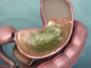 Гастрит атрофический