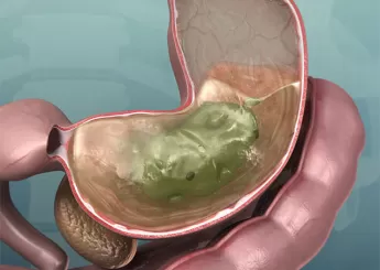 Гастрит атрофический