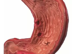 Гастрит эрозивный