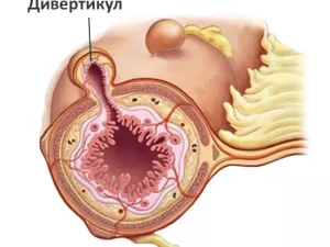 Дивертикулы пищевода