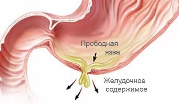 Методы лечения желудочно кишечного тракта