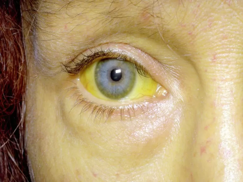 Один из главных симптомов это желтый оттенок глаз