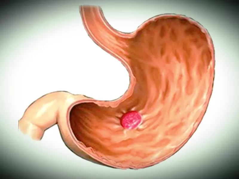 Прободение язвы желудка или двенадцатиперстной кишки — самая частая причина перитонита