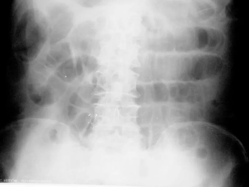 Рентгенограмма при перитоните: расширенные петли кишечника