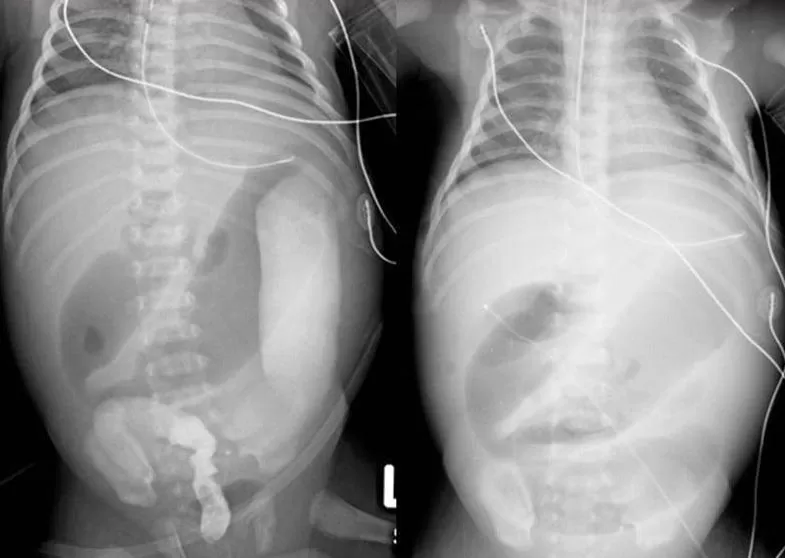 Рентгеновский снимок выраженной болезни Гиршпрунга